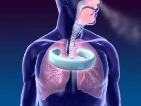 Laryngectomy