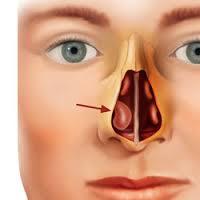 Turbinates Of Nose- Resection