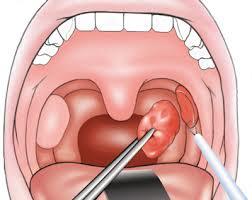 Tonsillectomy