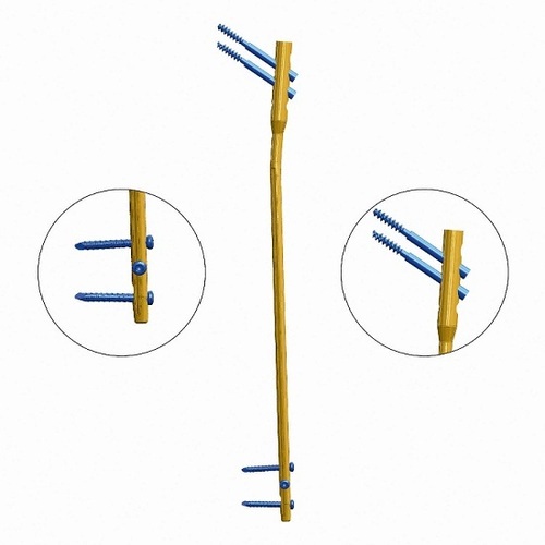 Antegrade Femoral Nail Bone Implants