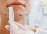 Chin Implant Surgery