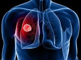 Lung Cancer