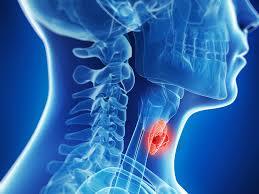 Head and Neck Cancer