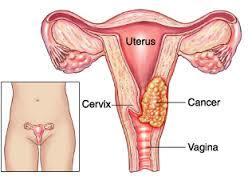 Cervical Cancer