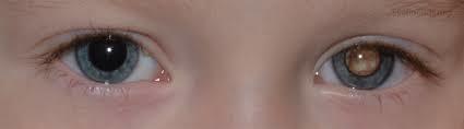 Retinoblastoma