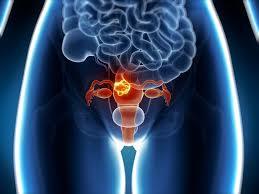 Uterine Cancer