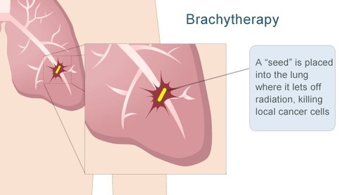 Brachytherapy