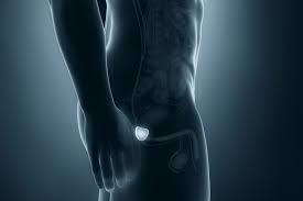Radical Prostatectomy