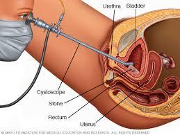 Cystoscopy