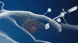 Laparoscopic Surgery