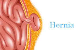 Hernia Treatment