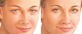 Cosmetic Eye Surgery