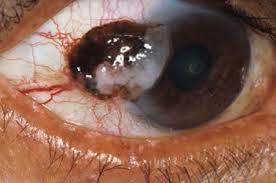 Eye Cancer Treatment