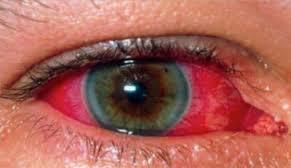 Uveitis