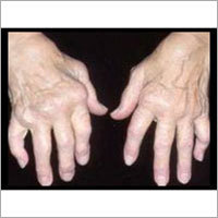 Arthritis equipments