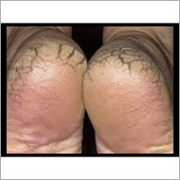 Foot wear for Foot Cracks