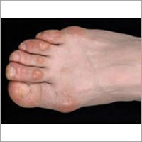 Foot Wear for Foot Corns