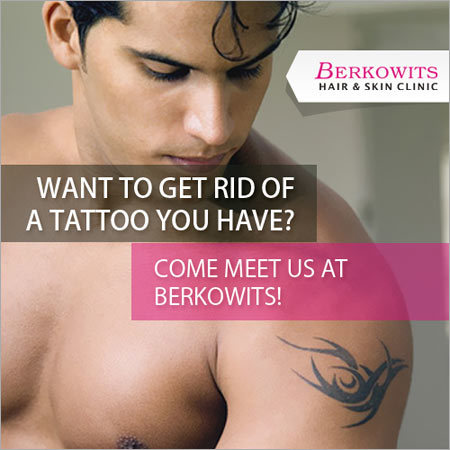 Laser Tattoo Removal Services