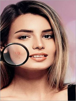 Acne Control Treatment