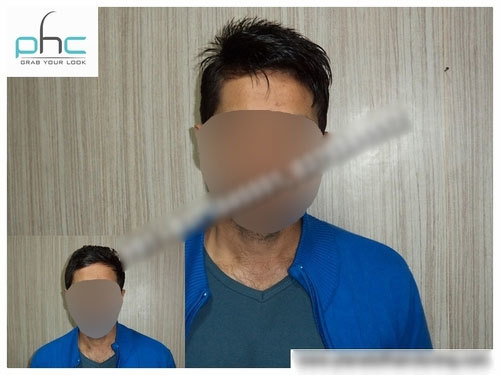 Wig Dealers in Aiims, Delhi-110017, India | Hair Wigs Dealers in Aiims.