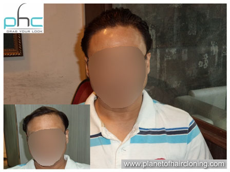 Mena s Hair Wigs (Best Shop) in Adarsh Nagar, Delhi-110033, India- Men Lace Wigs in Adarsh Nagar.