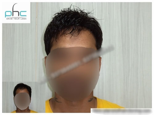 Human Hair Wigs for Cancer Patients in Ashok Vihar, Delhi-110052, India | Chemotherapy