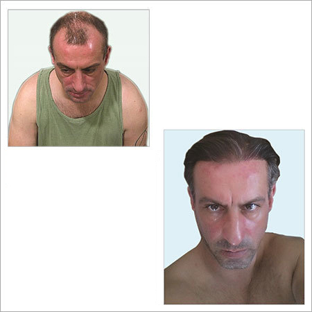 Hair Transplant Services
