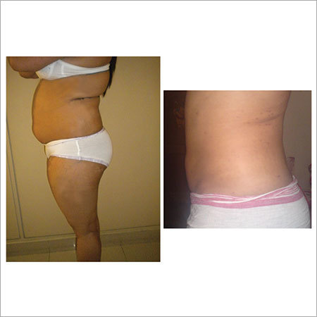 Liposuction Vaser Liposelection Surgery Services - Ultrasound Technology, General/Local Anesthesia | Fat Reduction, Body Sculpting, Inch Loss