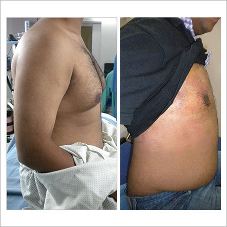 Gynecomastia Correction Surgery Services