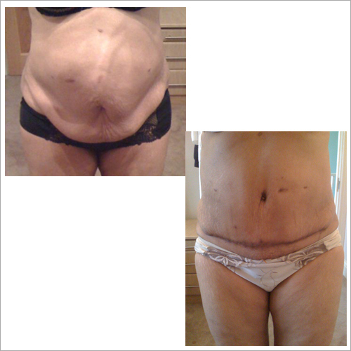 Abdominoplasty Surgery Services