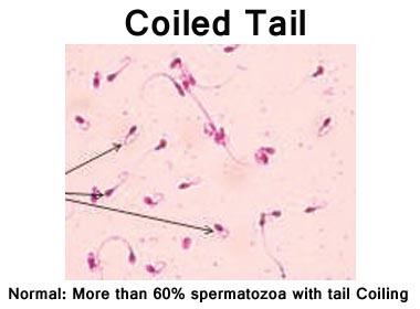 H.O.S. (Hypo- Osmotic Swelling Test)