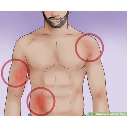 Rashes medicine
