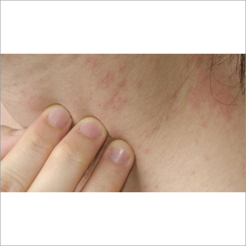 Allergi Medicine