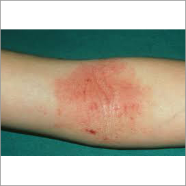 dermatitis