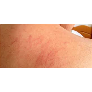 Lichen Planus Ointment