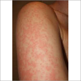 Eczema Cream