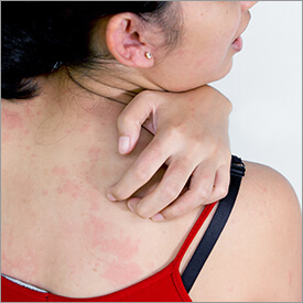 Ayurvedic Dermatitis medicine
