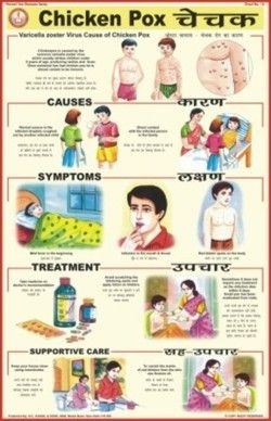 Chicken Pox Chart