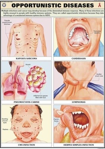 Opportunistic Diseases Chart