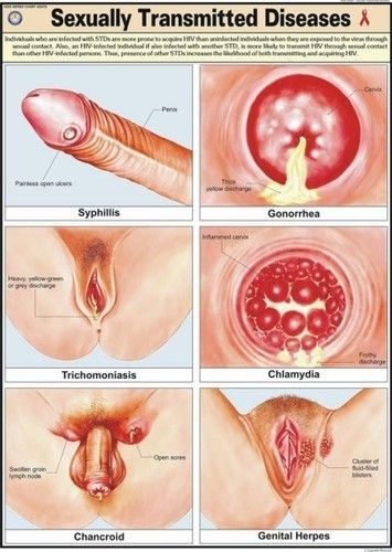 Sexually Transmitted Diseases Chart