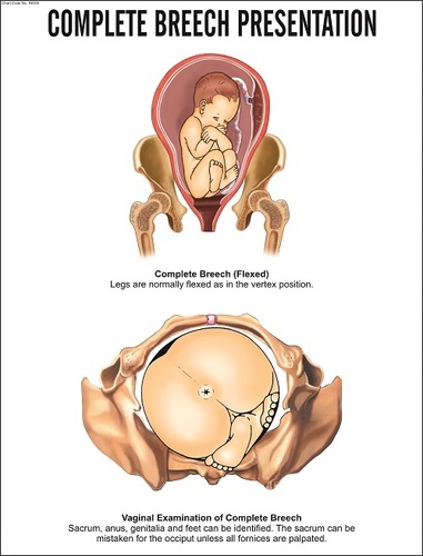 Complete Breech Presentation Chart