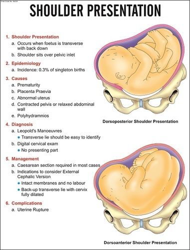 application of shoulder presentation