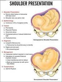 Shoulder Presentation Chart