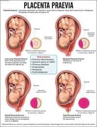Placenta Praevia Chart