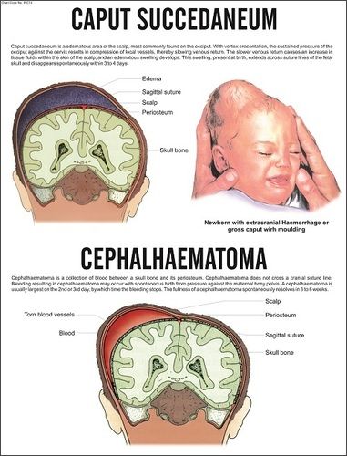 Caput Succedaneum -Cephalhaematoma Chart