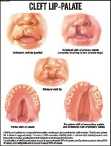 Cleft lip-Palate Chart