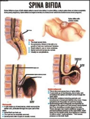Spina Bifida Chart