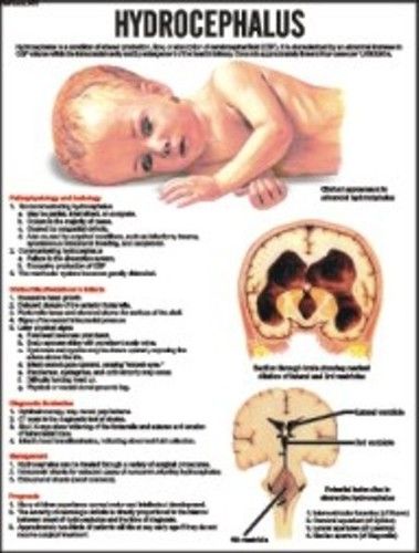 Hydrocephalus Chart