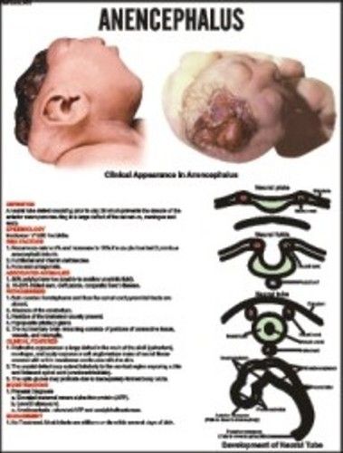 Anencephalus Chart