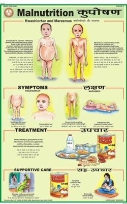 Malnutrition Chart